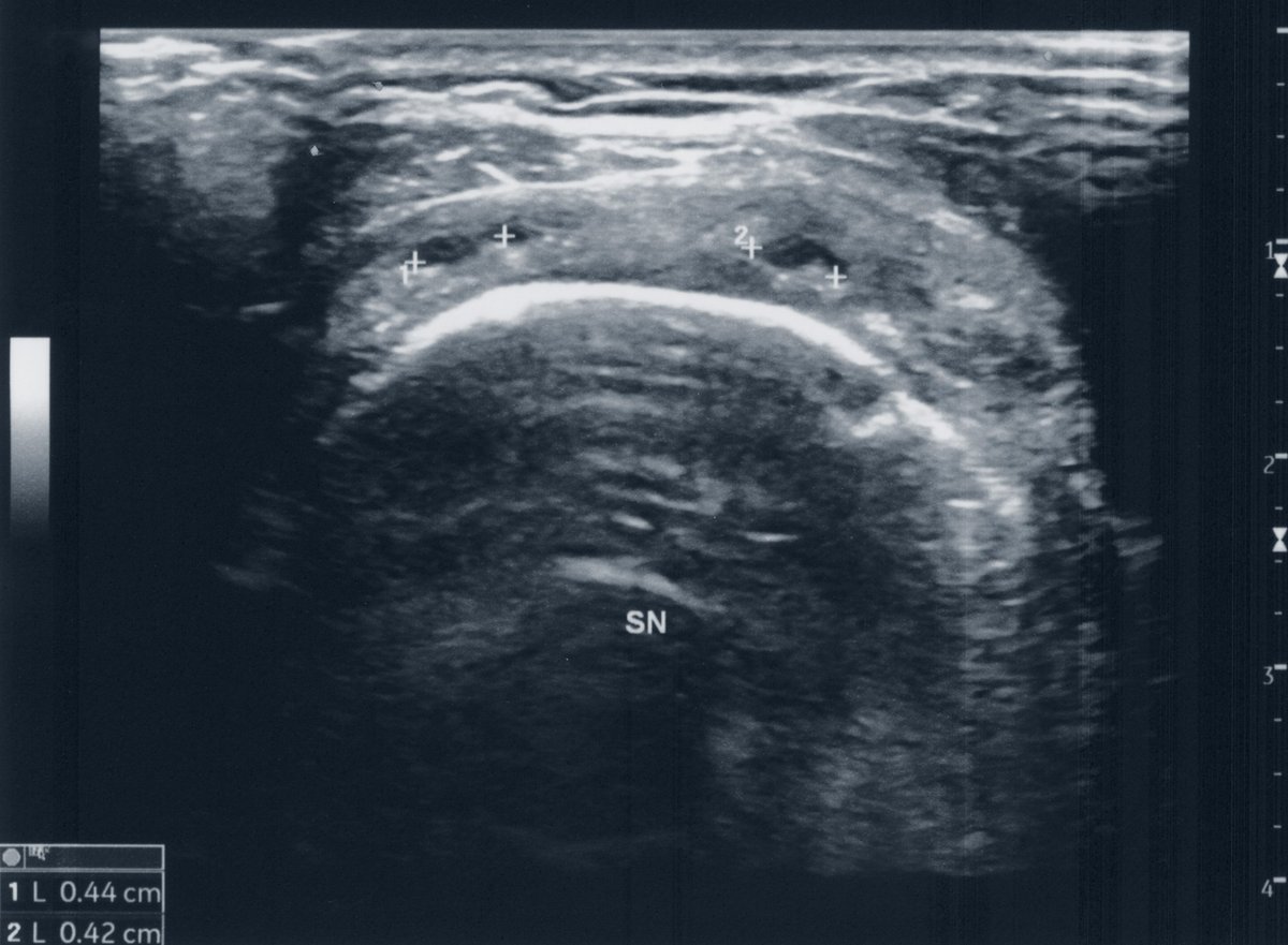 Imagen de ecografía musculoesquelética mostrando un tendón del manguito rotador con desgarro parcial