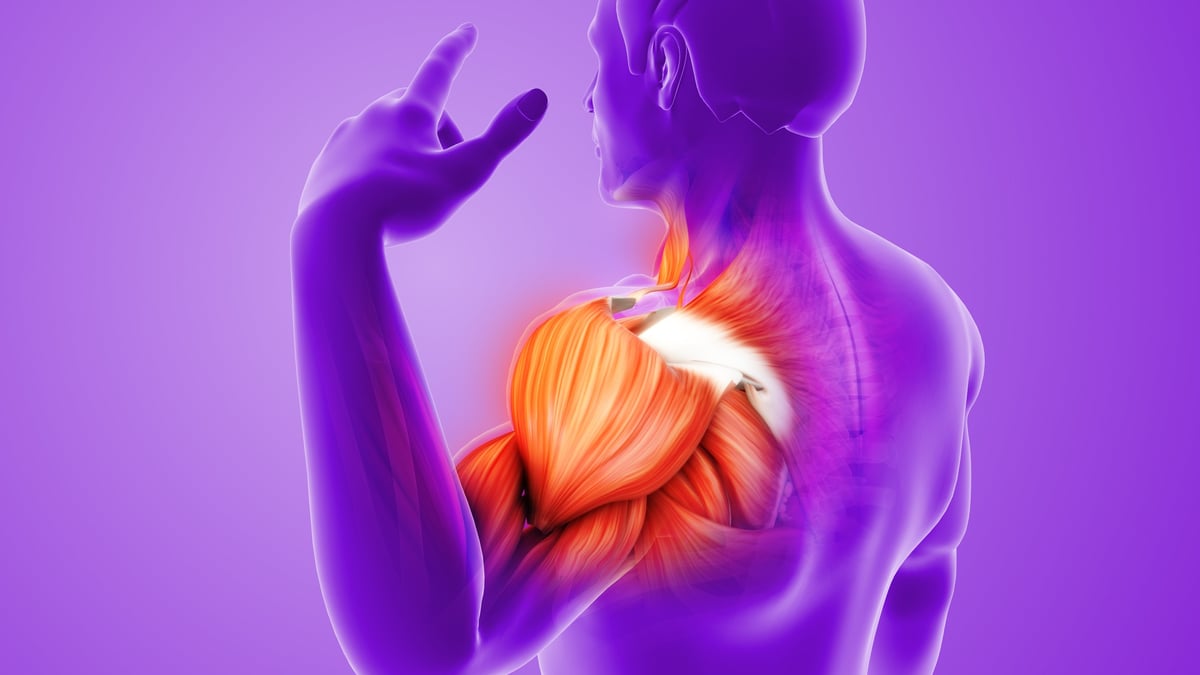 Ilustración anatómica mostrando los músculos y tendones inflamados del hombro con lesión del manguito rotador