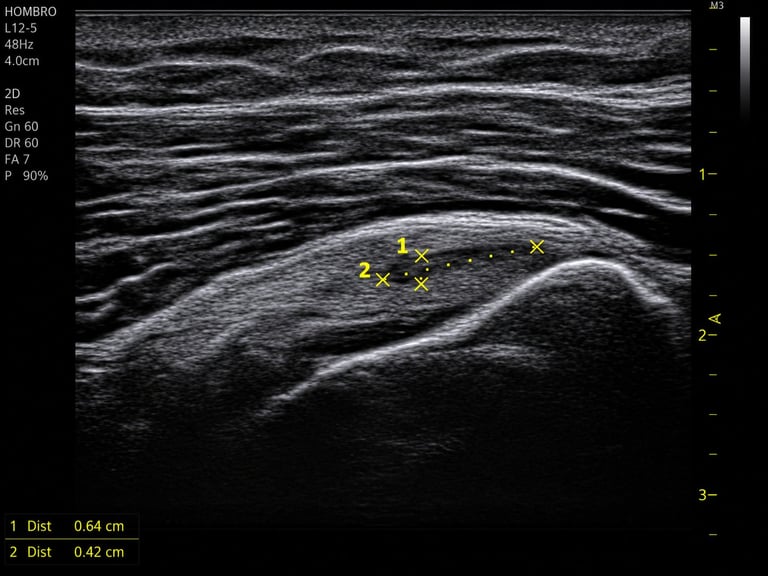 Ultrasound image of neck showing lymph node with yellow measurement markers